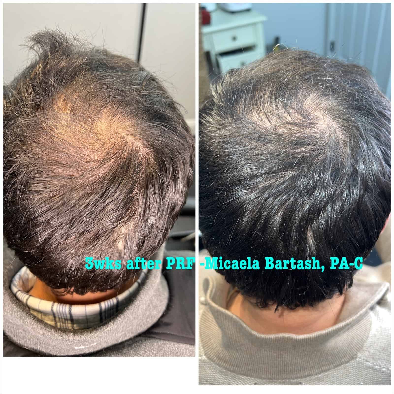 Hair Restoration in Charleston SC | Contour Mobile Aesthetics